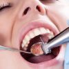 Стоматологические процедуры: лечение кариеса